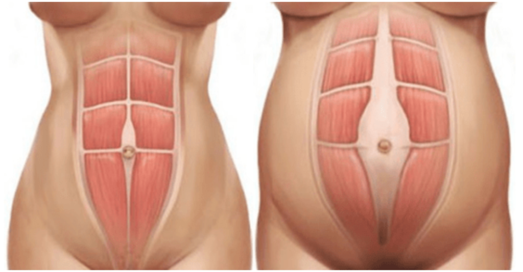 Everything you need to know about diastasis recti